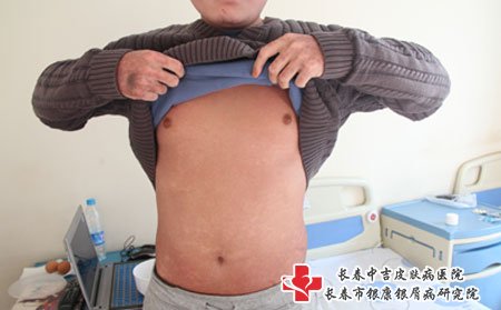 牛皮癣图片
