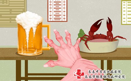 牛皮癣关节炎,怎样缓解牛皮癣关节炎