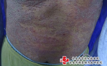 牛皮癣图片