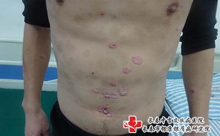 牛皮癣治疗