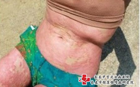 牛皮癣图片