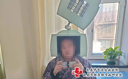 长春牛皮癣医院,长春正规的牛皮癣医院