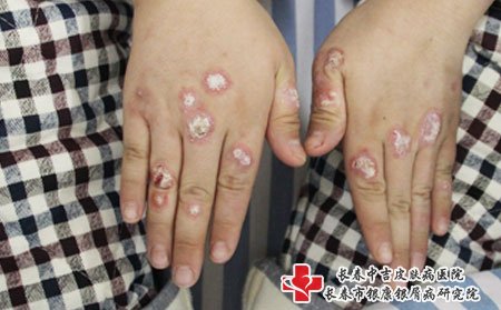 寻常型牛皮癣,寻常型牛皮癣治疗