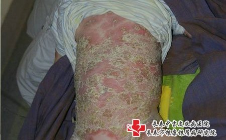 冬季牛皮癣,牛皮癣加重怎么办