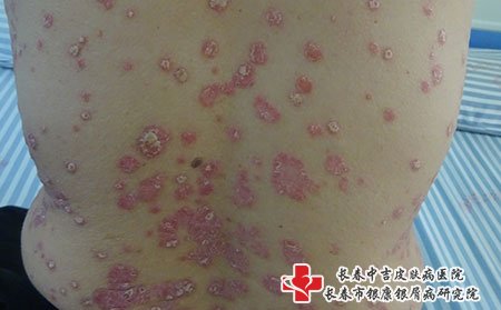 寻常型牛皮癣,寻常型牛皮癣病因