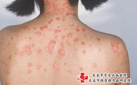 牛皮癣症状,儿童牛皮癣症状图片