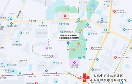 长春中吉牛皮癣医院地址