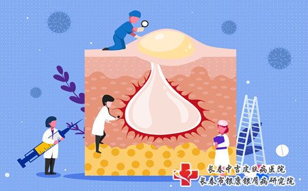 牛皮癣治疗,有效治牛皮癣方法