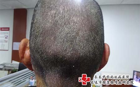 男人得牛皮癣的可能性为什么会越来越高?