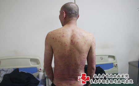 男人得牛皮癣的可能性为什么会越来越高?