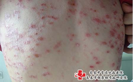 长春中吉牛皮癣医院好吗?牛皮癣能治好吗?
