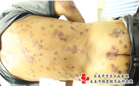 长春中吉牛皮癣医院：这些都是牛皮癣好转的征兆