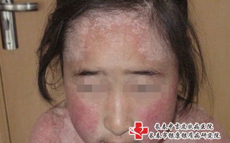 长春治疗牛皮癣的好医院有哪些?