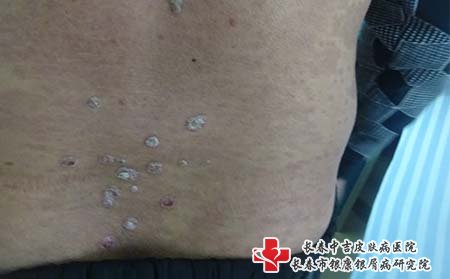 有什么办法可以预防牛皮癣?