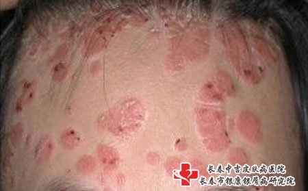 如何治疗脓疱型牛皮癣?