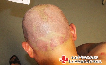 头癣如何治疗?