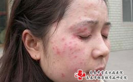 如何护理女性的牛皮癣