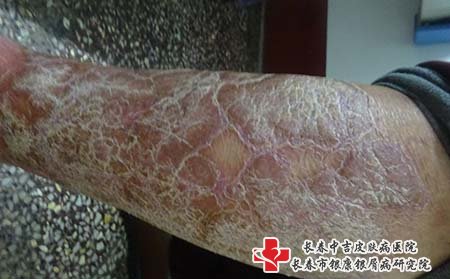 牛皮癣和鱼鳞病有什么区别?