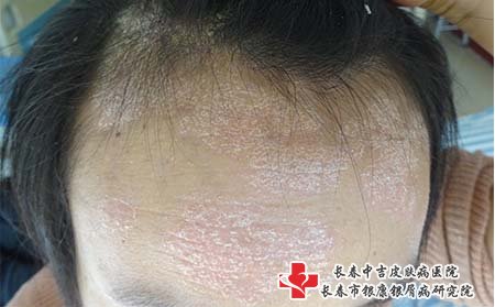 头部牛皮癣的症状是什么?