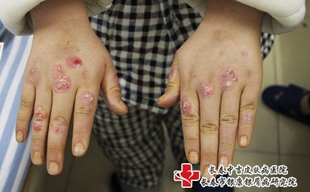 手部牛皮癣护理方法