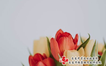 牛皮癣的病因是什么