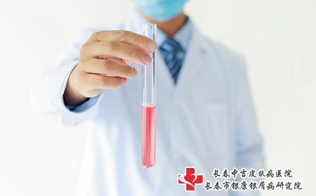 牛皮癣会不会传染,牛皮癣的治疗,牛皮癣的治疗费用