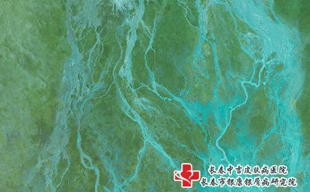 牛皮癣症状有哪些