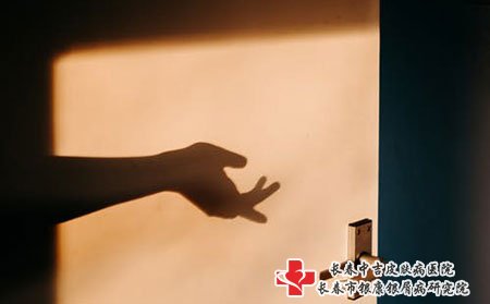 牛皮癣治疗方法有哪些