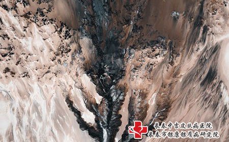 手部湿疹怎么护理才不会诱发牛皮癣?