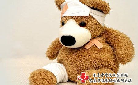 中医治疗牛皮癣的方法有哪些