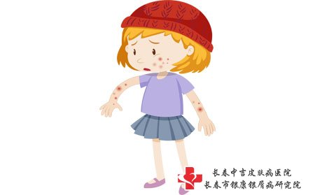 四肢牛皮癣有哪些症状