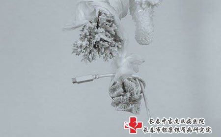 长春中吉牛皮癣医院带你走出牛皮癣就医的误区