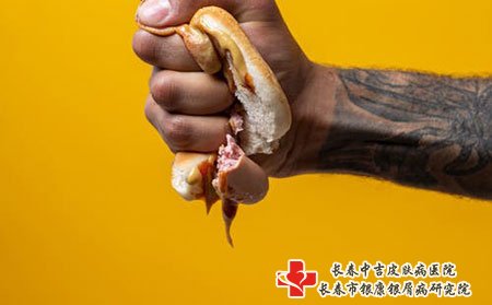 长春牛皮癣医院哪家好,长春中吉牛皮癣医院,长春哪家牛皮癣医院的治疗效果好呢