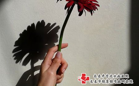 长春牛皮癣医院哪家好,长春中吉牛皮癣医院,长春哪家医院看疗牛皮癣好