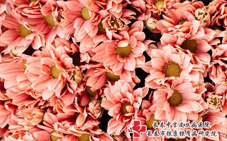 长春中吉牛皮癣医院介绍牛皮癣关节损害原因