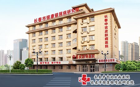 长春市中吉牛皮癣医院