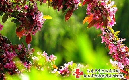 牛皮癣会不会自己好，怎样治疗好