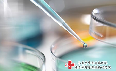 女性牛皮癣患者化妆的注意事项